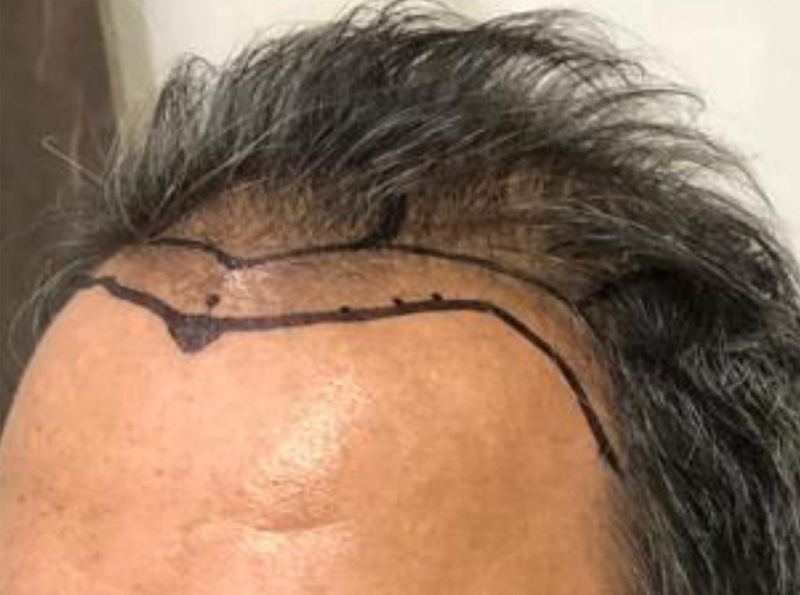 antes transplante capilar 1 - dr marcelo cortez