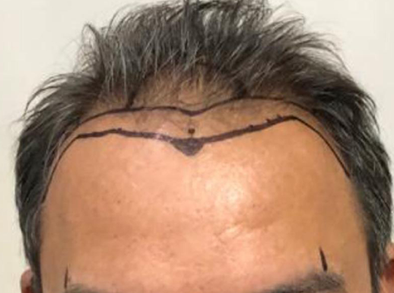 antes transplante capilar 2 - dr marcelo cortez