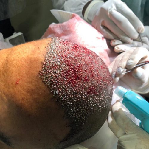 Transplante capilar - dr marcelo cortez 2